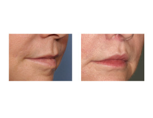 Cali Lip Lift results oblique view Dr Barry Eppley Indianapolis