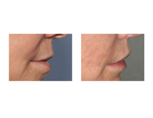 Cali Lip Lift results side view Dr Barry Eppley Indianapolis