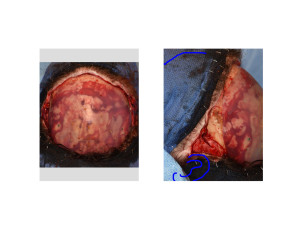 Custom Skull Cap Implant intraoperative placement Dr Barry Eppley Indianapolis