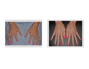 Fat Injections to Hands Dr Barry Eppley Indianapolis