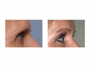 Female Pretrichial Broiwlift results side view Dr Barry Eppley Indianapolis