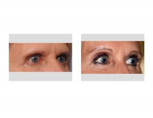Female Pretrichial Browlift result oblique view Dr Barry Eppley Indianapolis