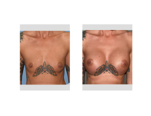 Moth Breast Augmentation results front view