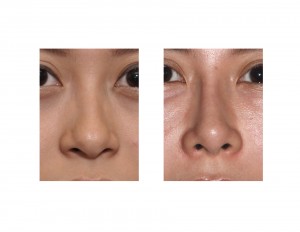Nasal Implant Rhinoplasty result front view Dr Barry Eppley Indianapolis