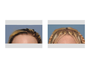 Skull Implant Augmentation result front view Dr Barry Eppley Indianapolis
