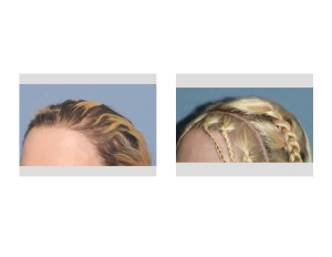 Skull Implant Augmentation result oblique view Dr Barry Eppley Indianapolis