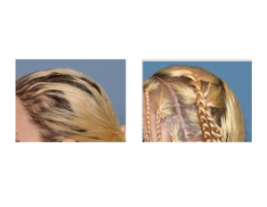 Skull Implant Augmentation result side view Dr Barry Eppley Indianapolis