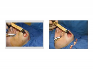 Submental Chiun Reduction bone removal Dr Barry Eppley Indianapolis