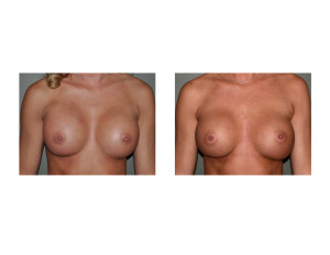 Breast Implant Settling front view Dr Barry Eppley Indianapolis