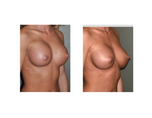 Breast Implant Settling oblique view Dr Barry Eppley Indianapolis