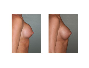 Breast Implant Settling side view Dr Barry Eppley Indianapolis