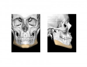 Custom Jawline Implant design Dr Barry Eppley Indianapolis