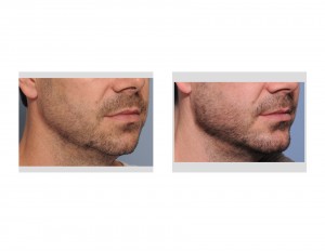 Custom Jawline Implant result oblique view Dr Barry Eppley Indianapolis