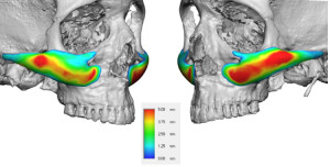 Custom Male Cheek Implant Thicknesses Dr Barry Eppley Indianapolis