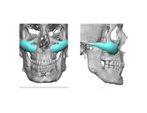 Custom Male Cheek Implants Dr Barry Eppley Indianapolis