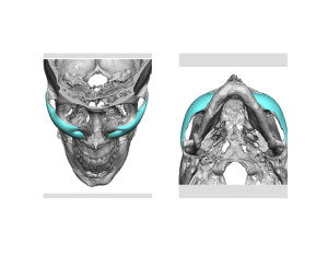 Custom Male Cheek Implants Indianapolis Dr Barry Eppley