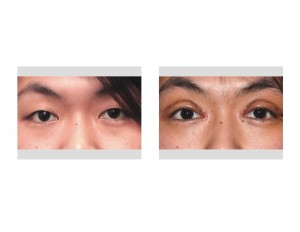 Double Eyelid Surgery swelling Dr Barry Eppley Indianapolis