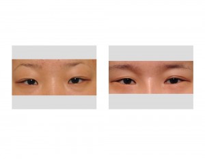 Double Upper Eyelid and Lower Eyelid Love Band Surgery Dr Barry Eppley Indianapolis