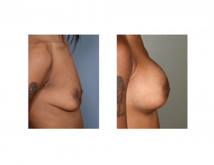 KA Breast augmentation results side view