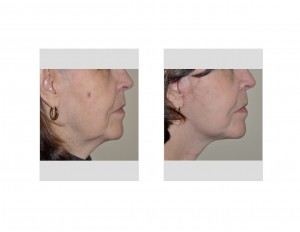 Limited Facelift (Quicklift) results side view Dr Barry Eppley Indianapolis