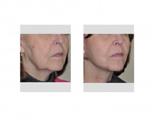 Limitred Facelift (Quicklift) results right oblique view Dr Barry Eppley Indianapolis