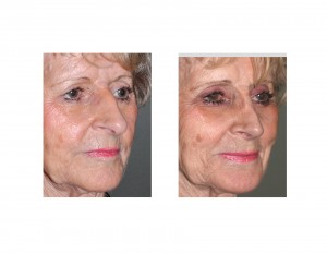 Mema Rhinoplasty result oblique view