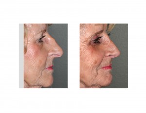 Mema Rhinoplasty result side view
