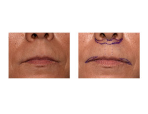Subnasal Lip Lift with Lateral Vermilion Advancement markings dr barry eppley indianapolis