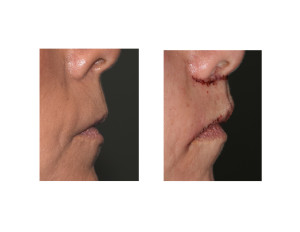 Subnasal Lip Lift with Lateral Vermilion Advancements result side view Dr Barry Eppley Indianapolis