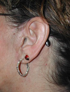 female facelift incision dr barry eppley indianapolis