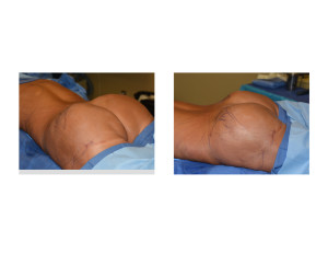 2nd Stage Fat Injections after Buttock Implants Dr Barry Eppley Indianapolis