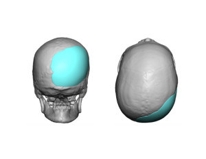 Adult Occipital Plagiocephaly Custom Skull Implant Design Dr Barry Eppley Indianapolis