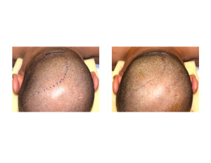 Adult Occipital Plagiocephaly Custom Skull Implant result intraop Dr Barry Eppley Indianapolis