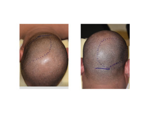 Adult Occipital Plagiocephaly Skull Implant Correction Dr Barry Eppley Indianapolis