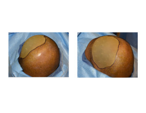 Adult Occipital Plagiocephaly Skull Implant intraop Dr Barry Eppley Indianapolis