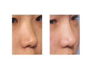 Asian Rib Graft Rhinoplasty result oblique view