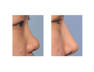 Asian Rib Graft Rhinoplasty result side view