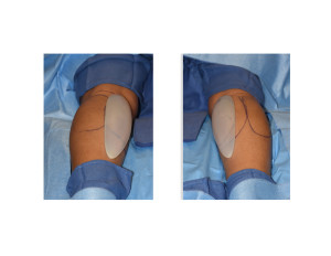 Calf Implant Sizing Dr Barry Eppley Indianapolis