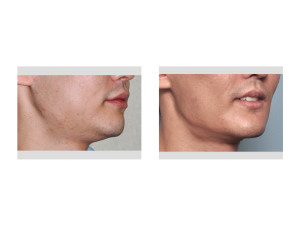 Custom Jawline Implant result oblique view Dr Barry Eppley Indianapolis
