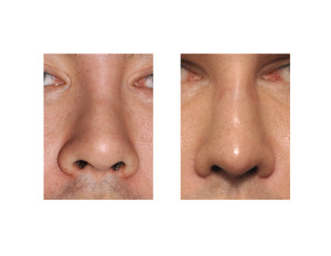 Custom Nasal Implant result front view Dr Barry Eppley Indianapolis