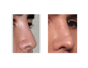 Custom Nasal Implant result oblique view Dr Barry Eppley Indianapolis