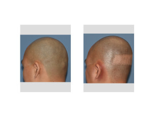 Custom Skull Implant and Occipital Knob Reduction result left oblique view Dr Barry Eppley Indianapolis