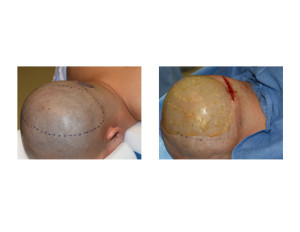 Custom Skull Implant placement intraop Dr Barry Eppley Indianapolis