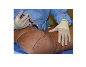 Fat Injections after Buttock Implants Dr Barry Eppley Indianapolis