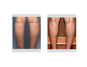 Female Inner Calf Implants result back view Dr Barry Eppley Indianapolis