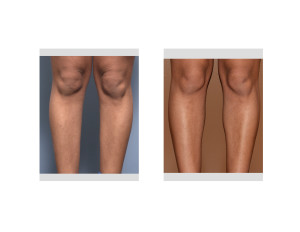 Female Inner Calf Implants result front view Dr Barry Eppley Indianapolis