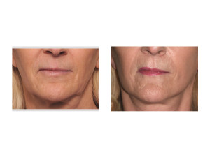 Female Lower Facelift result front view Dr Barry Eppley Indianapolis