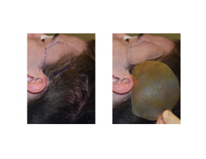 Head Widening Implants (anterior and posterior temporal implants Dr Barry Eppley Indianapolis