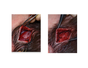 Head Widening Implants (implant placement and subafscial closure) Dr Barry Eppley Indianapolis