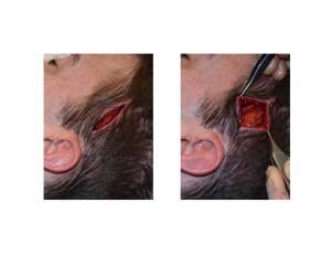 Head Widening Implants (incision and subfascial dissection) Dr Barry Eppley Indianapolis